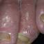 2. Wet Eczema Pictures