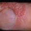 25. Wet Eczema Pictures
