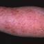 4. Wet Eczema Pictures
