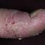 40. Wet Eczema Pictures