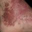 54. Wet Eczema Pictures