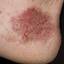 55. Wet Eczema Pictures