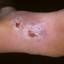60. Wet Eczema Pictures