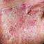 70. Wet Eczema Pictures