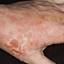 95. Wet Eczema Pictures