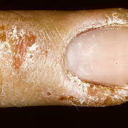 Weeping Eczema on Hands