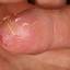 2. Weeping Eczema on Hands Pictures