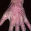 35. Weeping Eczema on Hands Pictures