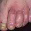 1. Weeping Eczema on the feet Pictures