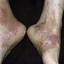 10. Weeping Eczema on the feet Pictures