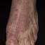 11. Weeping Eczema on the feet Pictures