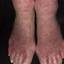 12. Weeping Eczema on the feet Pictures