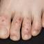 13. Weeping Eczema on the feet Pictures