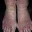 14. Weeping Eczema on the feet Pictures
