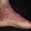 16. Weeping Eczema on the feet Pictures