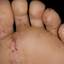 19. Weeping Eczema on the feet Pictures