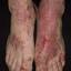 23. Weeping Eczema on the feet Pictures