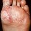 27. Weeping Eczema on the feet Pictures