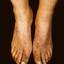 28. Weeping Eczema on the feet Pictures