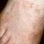 29. Weeping Eczema on the feet Pictures