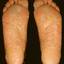 30. Weeping Eczema on the feet Pictures