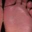 33. Weeping Eczema on the feet Pictures