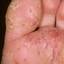 35. Weeping Eczema on the feet Pictures
