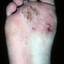 40. Weeping Eczema on the feet Pictures