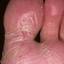 41. Weeping Eczema on the feet Pictures