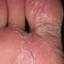 42. Weeping Eczema on the feet Pictures