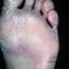 44. Weeping Eczema on the feet Pictures
