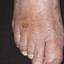 5. Weeping Eczema on the feet Pictures