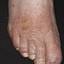 6. Weeping Eczema on the feet Pictures