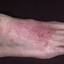 64. Weeping Eczema on the feet Pictures