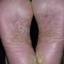 7. Weeping Eczema on the feet Pictures