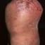 77. Weeping Eczema on the feet Pictures