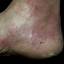 9. Weeping Eczema on the feet Pictures