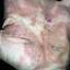 35. Microbial Eczema on Hands Pictures