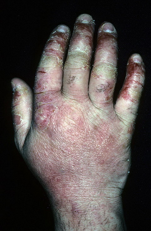 Microbial Eczema on Hands Pictures – 54 Photos & Images / illnessee.com
