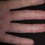 104. Eczema Hands Pictures