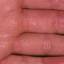 113. Eczema Hands Pictures