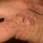 116. Eczema Hands Pictures