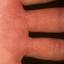 117. Eczema Hands Pictures