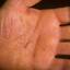 120. Eczema Hands Pictures