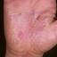 131. Eczema Hands Pictures