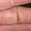 135. Eczema Hands Pictures