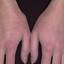 136. Eczema Hands Pictures