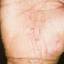 139. Eczema Hands Pictures
