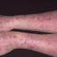 14. Eczema Hands Pictures
