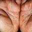 141. Eczema Hands Pictures